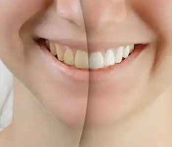 Teeth Whitening